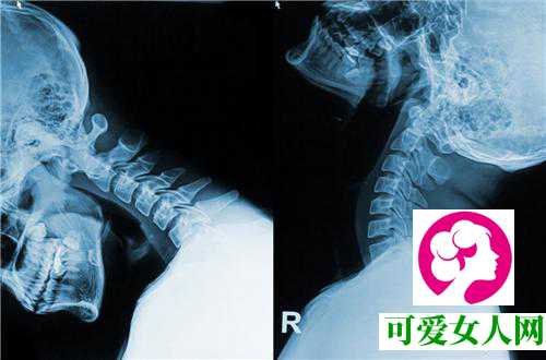 颈椎引起的头晕怎么办