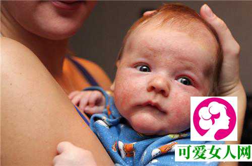 婴儿湿疹和痱子的五大区别，你知道吗？